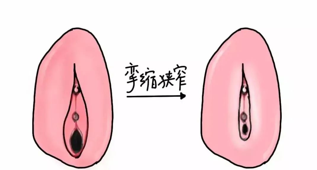 外阴白斑影响怀孕吗？ 