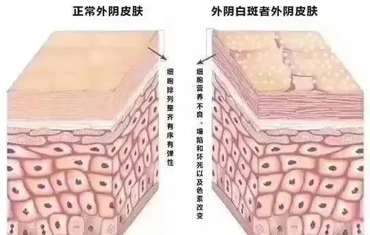 为什么会患外阴白斑？