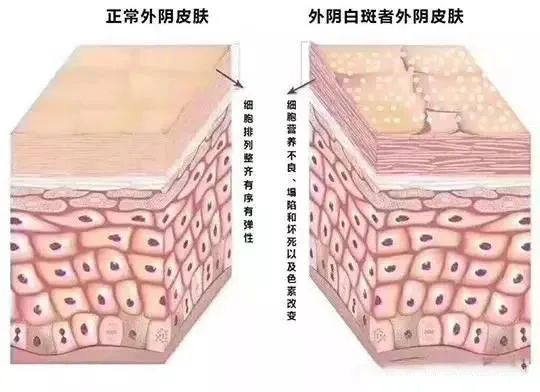 轻度外阴白斑只擦药能治愈吗？