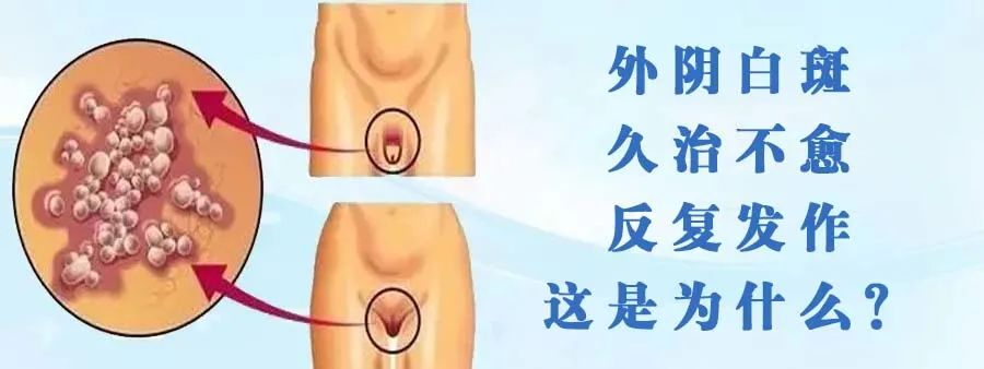 外阴白斑疾病怎么治?