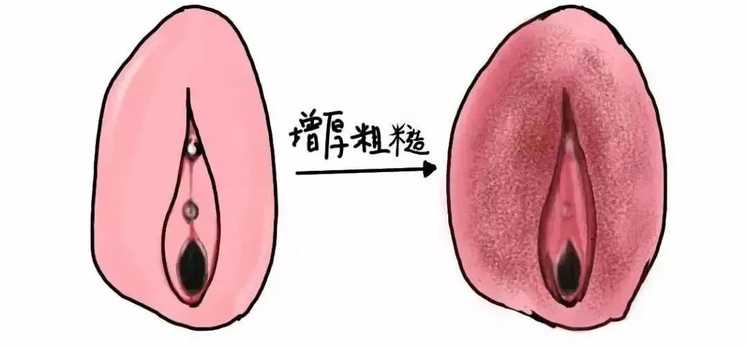 患上外阴白斑是什么颜色