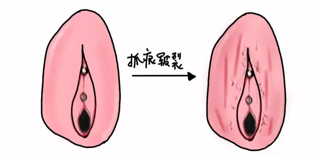 外阴白斑疾病怎么自测