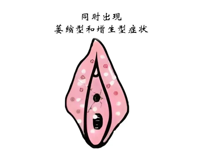 患上外阴白斑后有什么症状表现