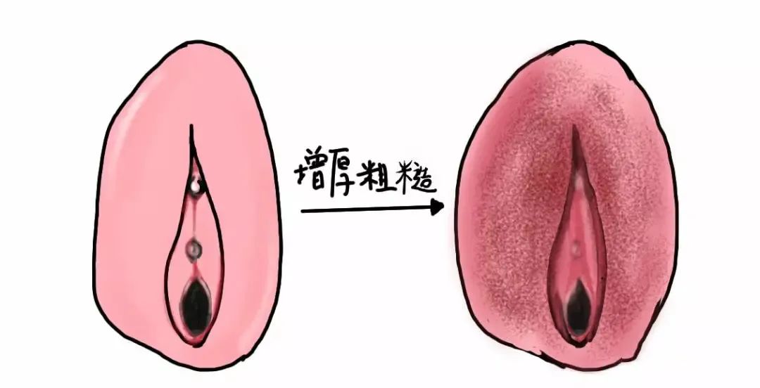 外阴白斑的症状有哪些
