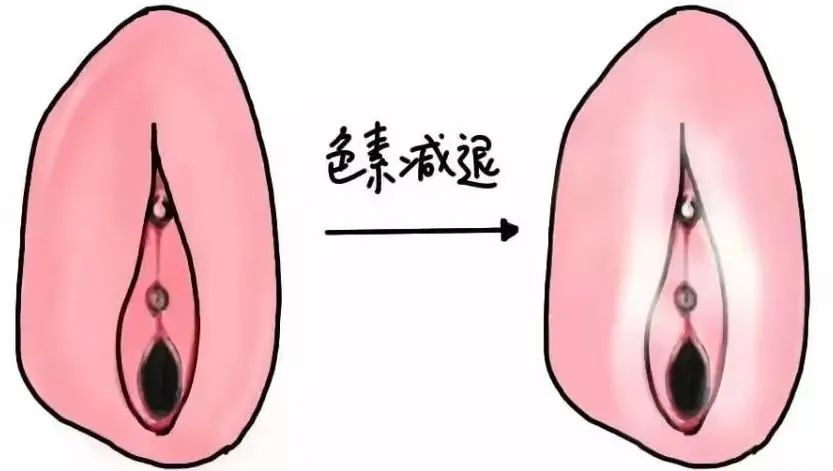 外阴白斑会因为哪些因素加快扩散？