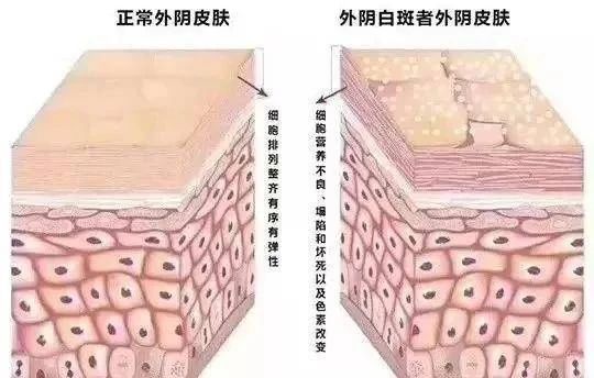 外阴白斑是性病吗？
