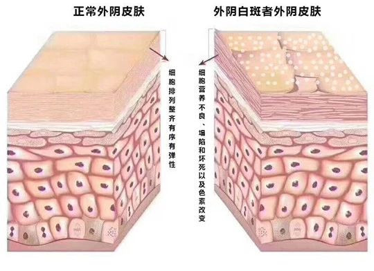 外阴白斑好转的迹象都有哪些？
