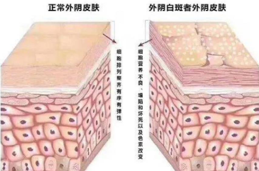 外阴营养不良是什么导致的？