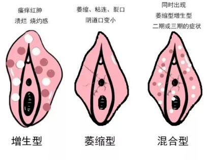 怎么区分外阴白斑和外阴湿疹? 怎么区分外阴白斑和外阴湿疹?