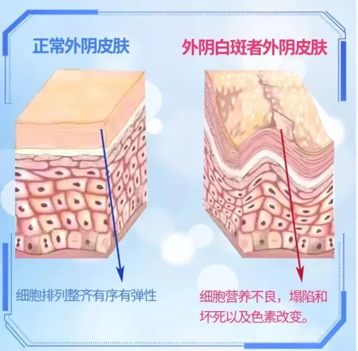 得了外阴白斑后为什么要做专项检查? 得了外阴白斑后为什么要做专项检查?