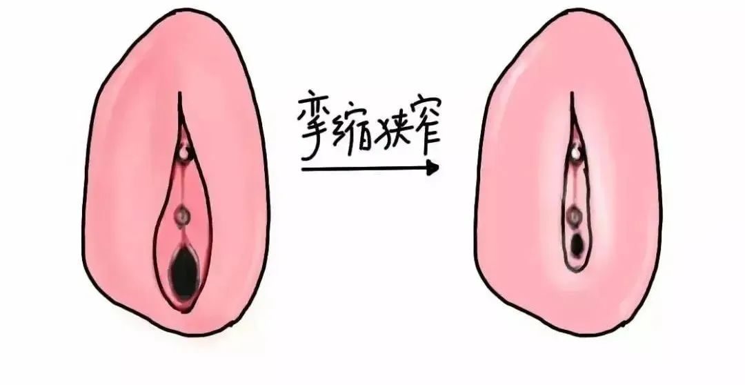 患上外阴白斑是什么颜色 患上外阴白斑是什么颜色