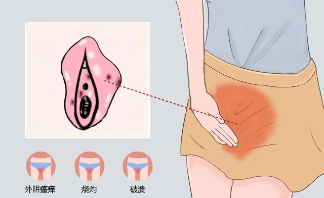 女性的阴道炎和外阴白斑疾病不同之处有哪些? 女性的阴道炎和外阴白斑疾病不同之处有哪些?
