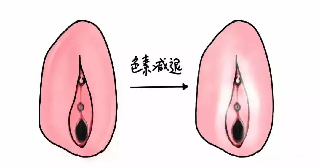 外阴白斑初期四种最明显的症状 外阴白斑初期四种最明显的症状