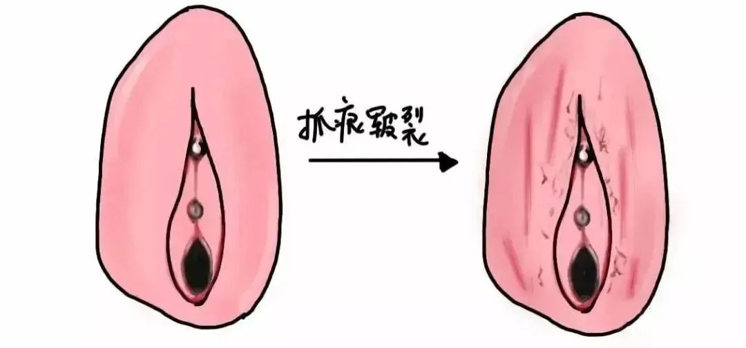 患上外阴白斑是什么颜色 患上外阴白斑是什么颜色