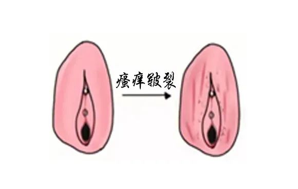 得了外阴白斑后外阴会变成什么颜色? 得了外阴白斑后外阴会变成什么颜色?