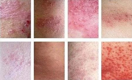 怎么区分外阴白斑和外阴湿疹? 怎么区分外阴白斑和外阴湿疹?