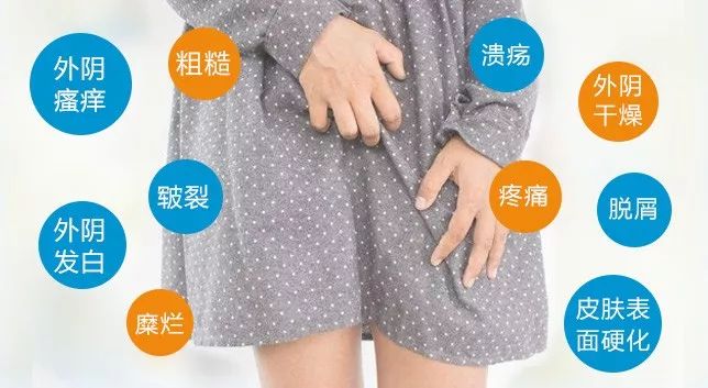 外阴白斑如何规范治疗？