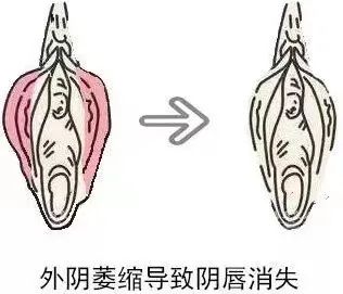 外阴白斑是属于哪种类型的疾病? 外阴白斑是属于哪种类型的疾病?