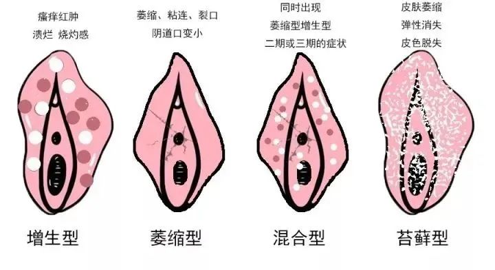 外阴白斑与外阴湿疹有什么不同? 外阴白斑与外阴湿疹有什么不同?