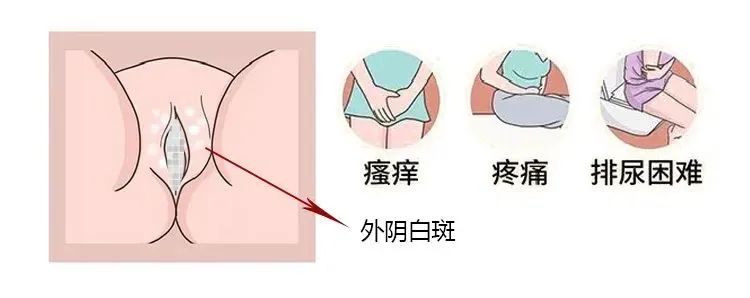 混合型外阴白斑的病因和危害都有哪些? 混合型外阴白斑的病因和危害都有哪些?