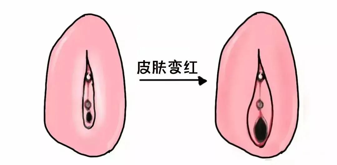 外阴白斑好转的迹象有哪些? 外阴白斑好转的迹象有哪些?