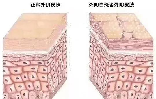得了外阴白斑后外阴会变成什么颜色? 得了外阴白斑后外阴会变成什么颜色?