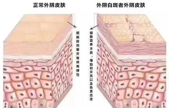 夏季外阴白斑患者日常饮食应该注意些什么？