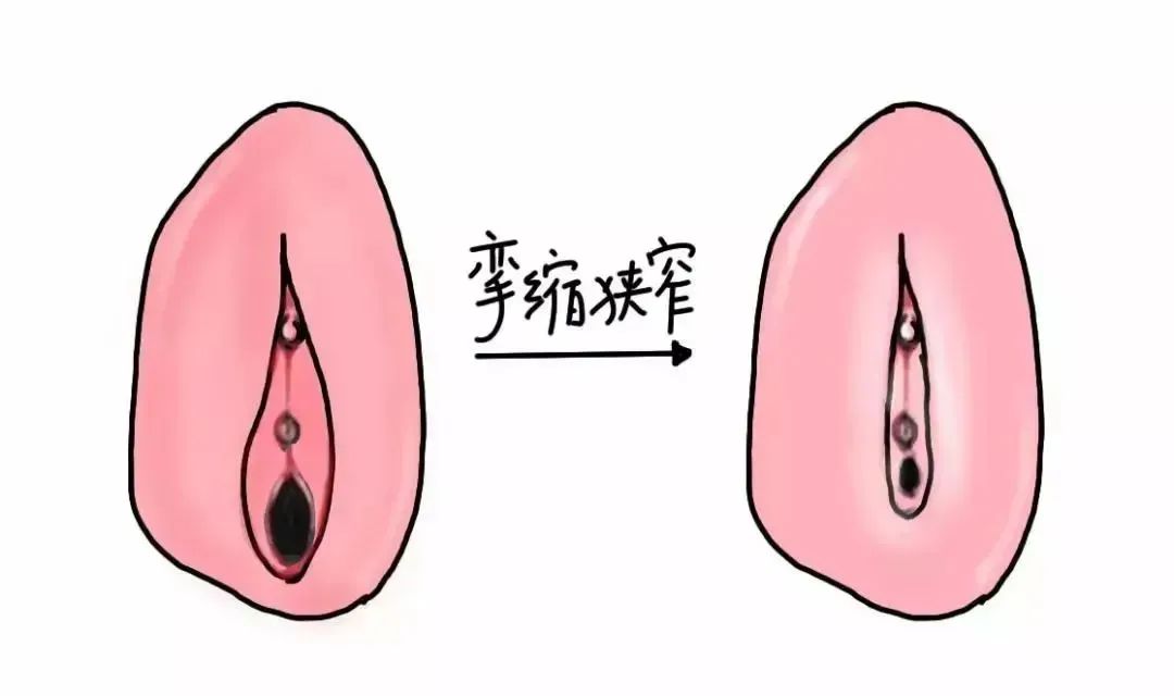 患上外阴白斑病后外阴皮肤颜色一定会变白吗? 患上外阴白斑病后外阴皮肤颜色一定会变白吗?