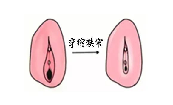 得了外阴白斑后外阴会变成什么颜色? 得了外阴白斑后外阴会变成什么颜色?