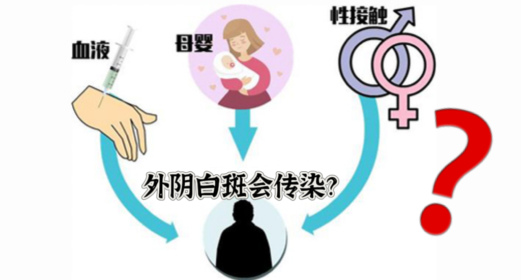 外阴白斑是否具有传染性? 外阴白斑是否具有传染性?