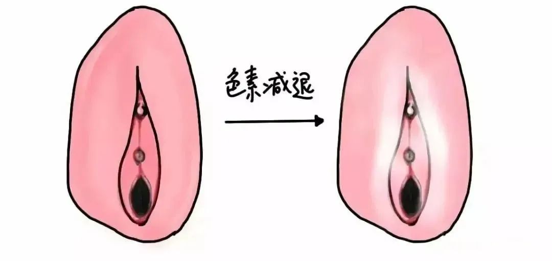 患上外阴白斑是什么颜色 患上外阴白斑是什么颜色