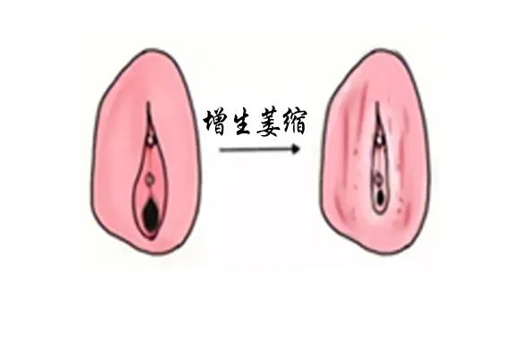 得了外阴白斑后外阴会变成什么颜色? 得了外阴白斑后外阴会变成什么颜色?