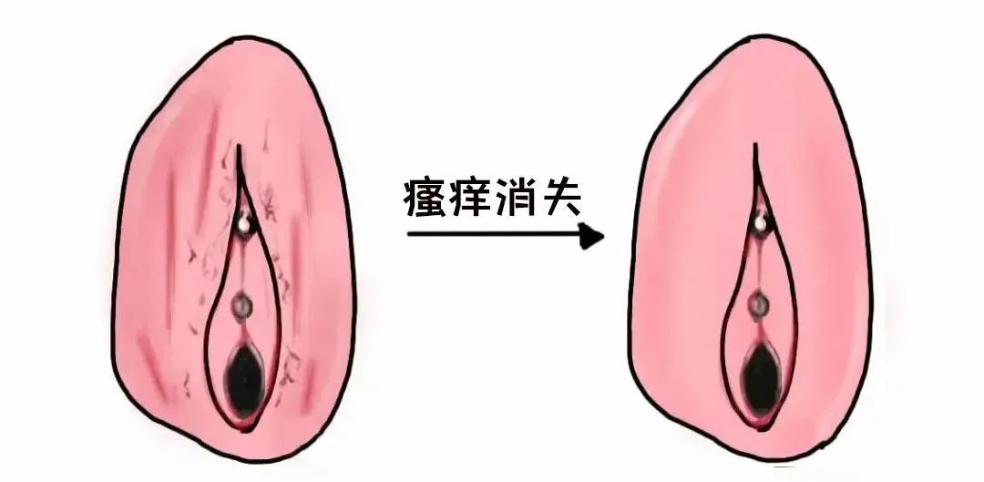 外阴白斑好转的迹象有哪些? 外阴白斑好转的迹象有哪些?