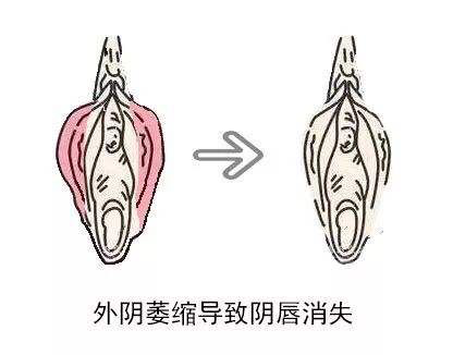 外阴白斑除了灼热,疼痛还有哪些表现? 外阴白斑除了灼热,疼痛还有哪些表现?