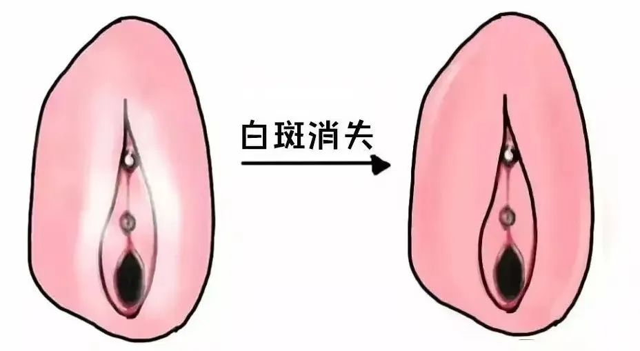 外阴白斑患者如何快速复色? 外阴白斑患者如何快速复色?
