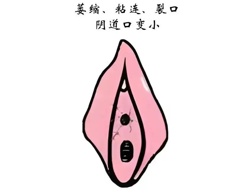 患上外阴白斑后外阴皮肤都有哪些变化? 患上外阴白斑后外阴皮肤都有哪些变化?
