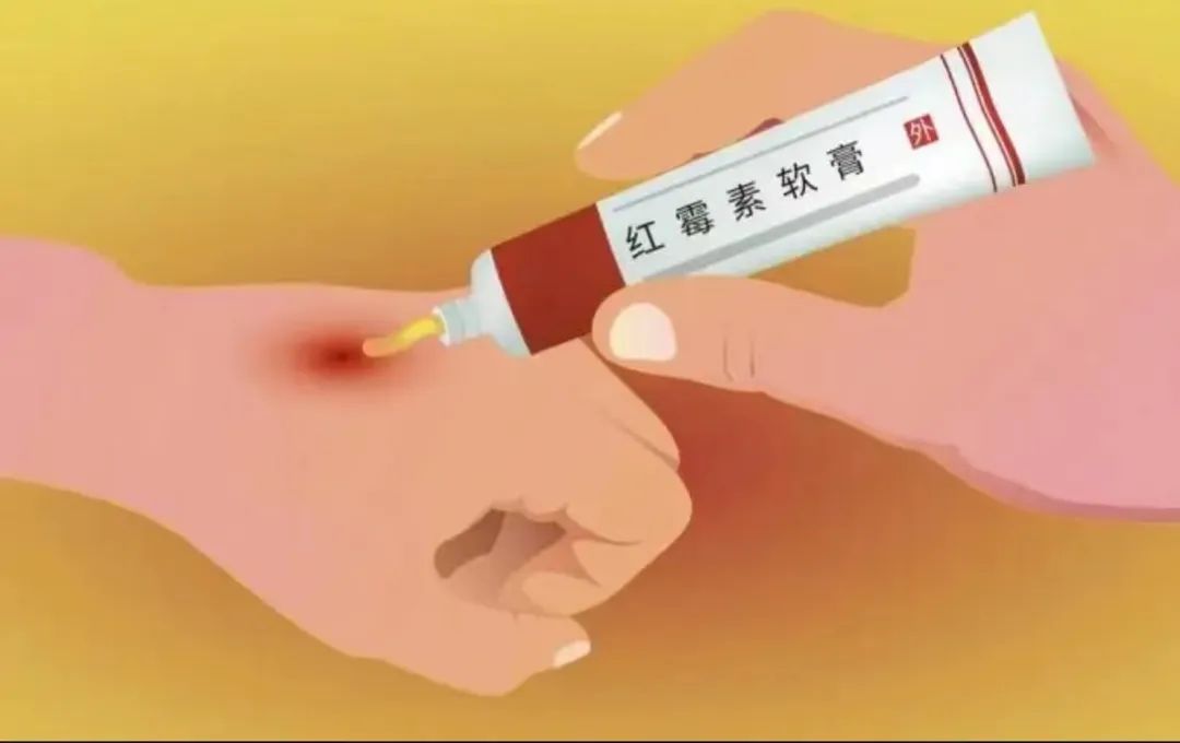 红霉素软膏可以治疗外阴白斑吗? 红霉素软膏可以治疗外阴白斑吗?