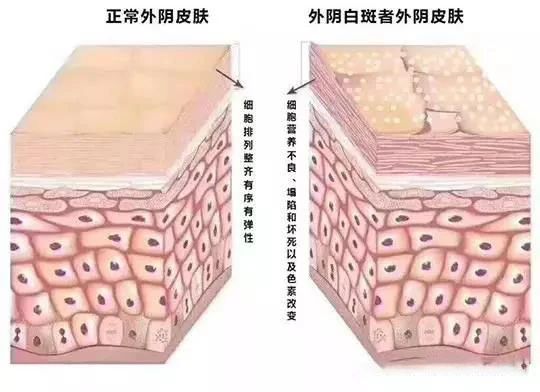 外阴白斑真的能自愈吗? 外阴白斑真的能自愈吗?