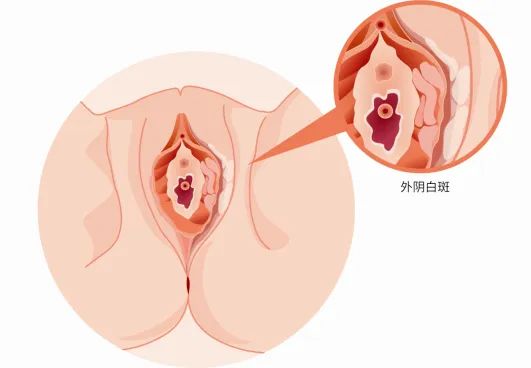 外阴白斑是属于哪种类型的疾病? 外阴白斑是属于哪种类型的疾病?