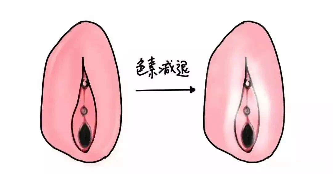 外阴营养不良是什么原因造成的? 外阴营养不良是什么原因造成的?