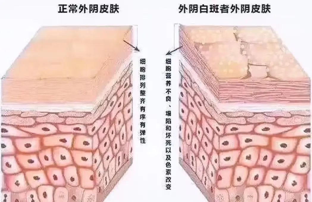 外阴白斑患者为什么会脱屑? 外阴白斑患者为什么会脱屑?